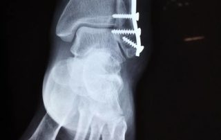 bone plate and screws - common broken bone for airline workers and bike messangers