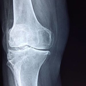 x-ray of the knee of forklift operator